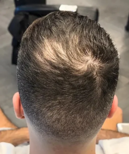 Haarausfall Mann Oberkopf – lichte Stelle am Scheitel vor Anwendung von CAVORIA Haar Kaschierpuder