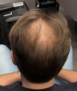 Kahle Stelle am Oberkopf eines Mannes – Haarausfall Scheitel vor Behandlung mit CAVORIA Haar Kaschierpuder