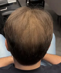 Lichtes Haar am Oberkopf – Mann mit Haarausfall von oben, Ausgangszustand vor CAVORIA Kaschierpuder