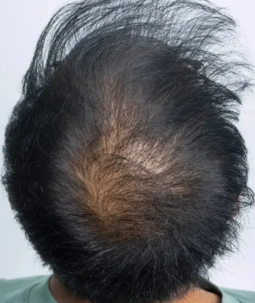 Starker Haarausfall Oberkopf – Mann mit lichtem Haar und sichtbarer Kopfhaut, Vorher-Bild CAVORIA