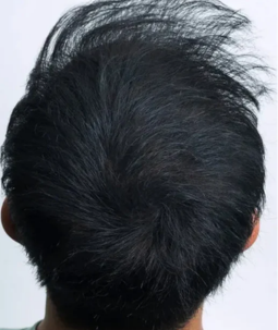 Haarausfall schwarzes Haar – Mann mit lichtem Scheitel von oben, Vorher-Ansicht CAVORIA Kaschierpuder