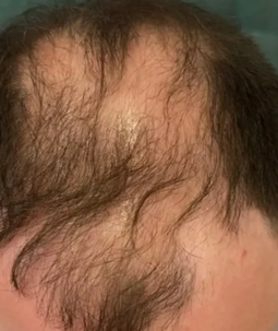 Starke Geheimratsecken und Haarausfall – Mann mit sichtbarer Kopfhaut von oben, Vorher-Bild CAVORIA