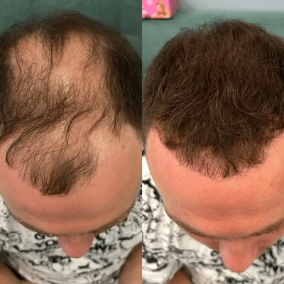 Haarausfall Vorher Nachher – Mann mit starken Geheimratsecken und lichtem Haar, nach CAVORIA Kaschierpuder volles dichtes Haar