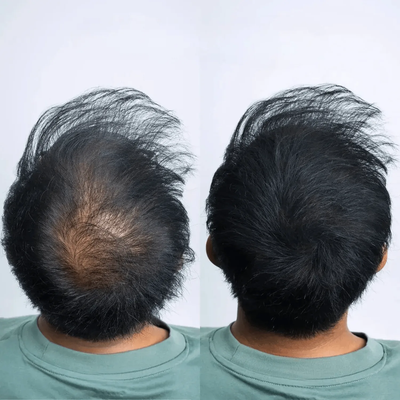 Haarausfall Oberkopf Vorher Nachher – Mann von hinten mit kahler Stelle, nach CAVORIA Kaschierpuder volles schwarzes Haar