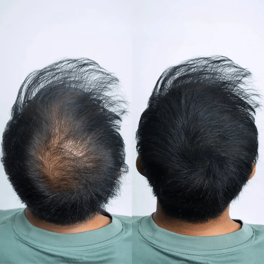 Haarausfall Oberkopf Vorher Nachher – Mann von hinten mit kahler Stelle, nach CAVORIA Kaschierpuder volles schwarzes Haar